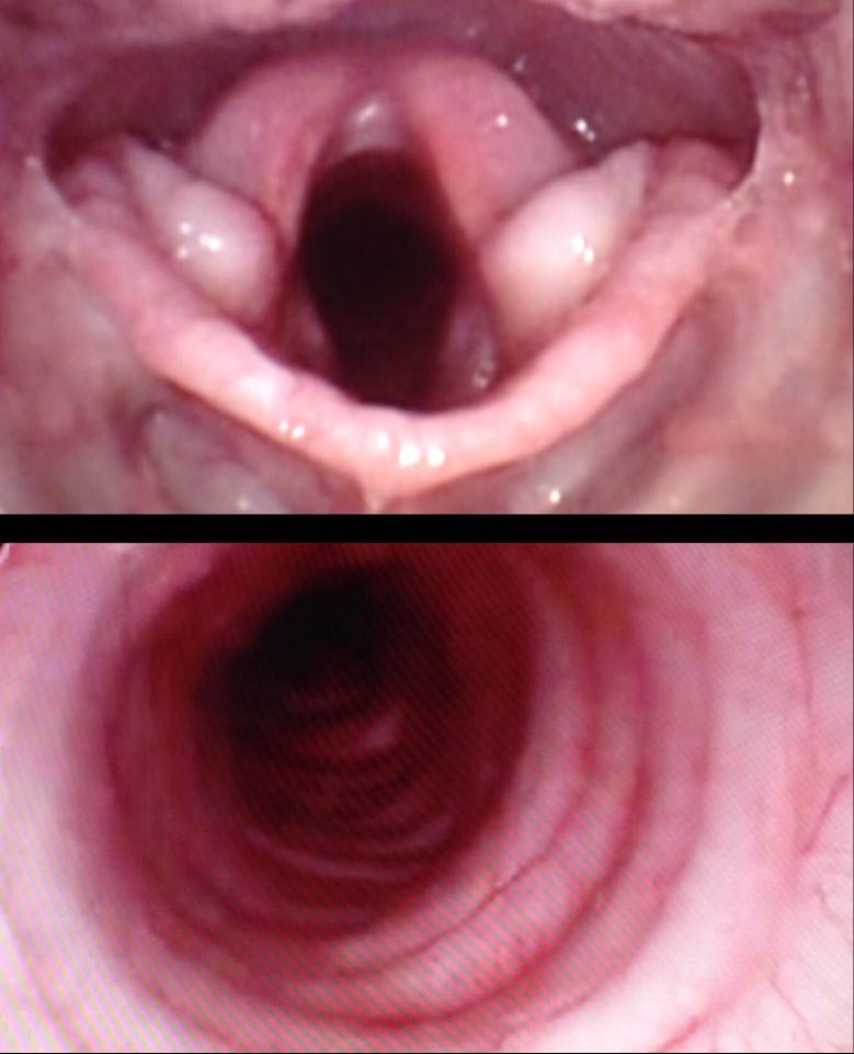 Laryngo