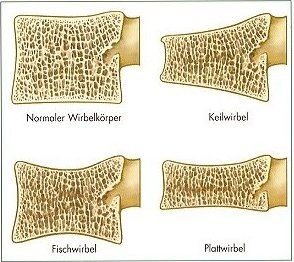 wirbel2